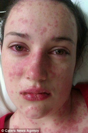 Kάηκε το δέρμα 19χρονη από μέσα προς τα έξω από λάθος φάρμακο danika3