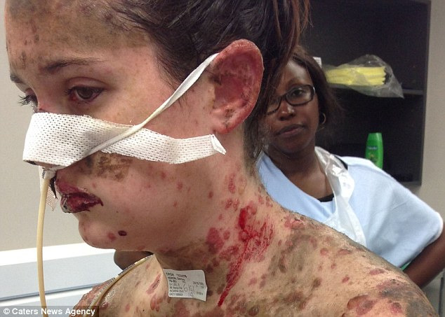 Kάηκε το δέρμα 19χρονη από μέσα προς τα έξω από λάθος φάρμακο egk-10