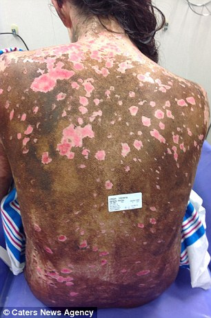 Kάηκε το δέρμα 19χρονη από μέσα προς τα έξω από λάθος φάρμακο egk-2