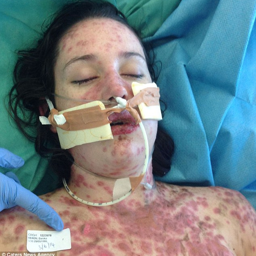 Kάηκε το δέρμα 19χρονη από μέσα προς τα έξω από λάθος φάρμακο egk-527_0